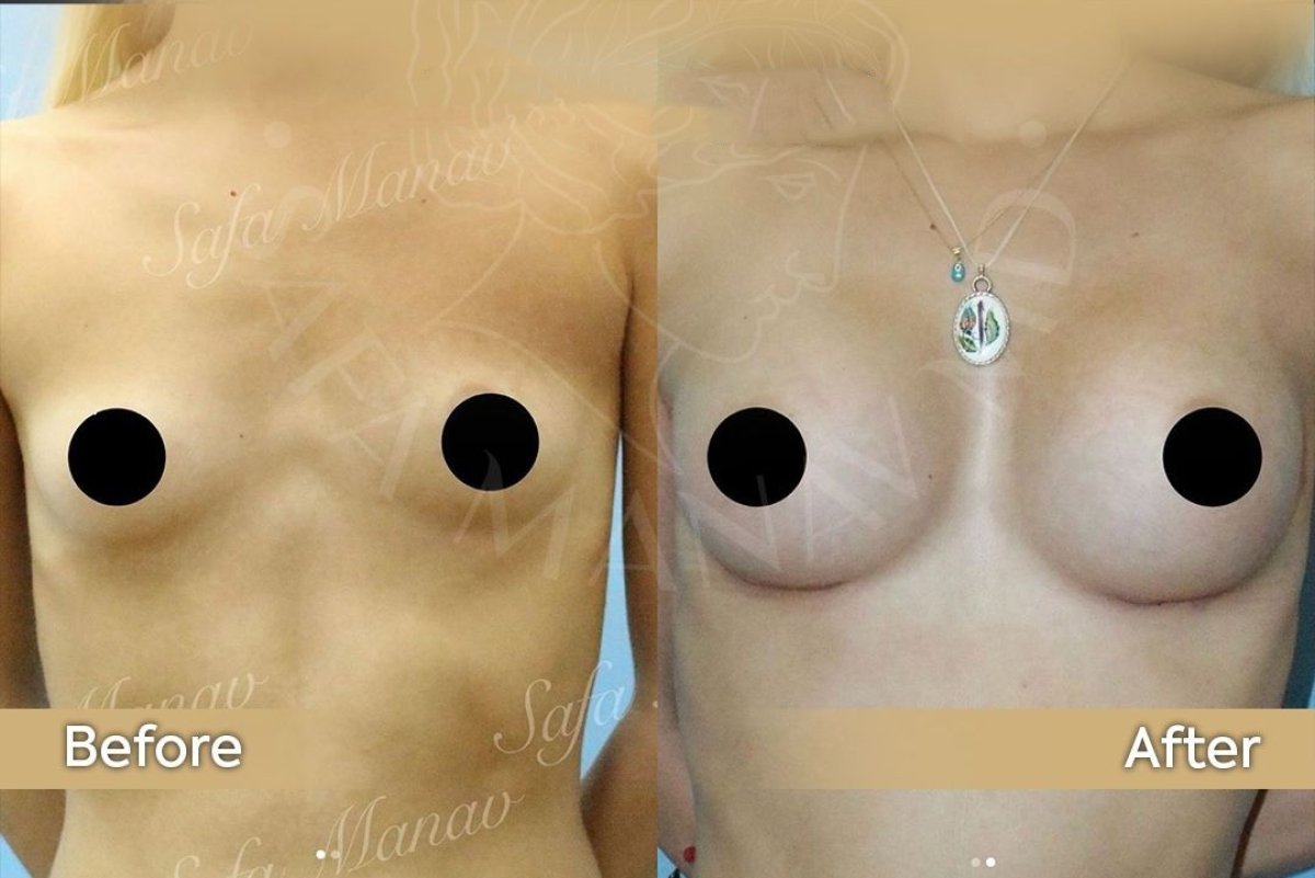 Antes y después de mastopexia con implantes redondos en Dr. Safa Manav Clinic, resultado