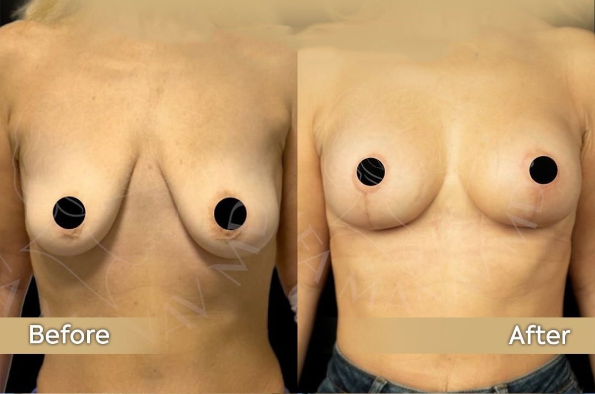 Résultat avant/après lifting mammaire avec implants ronds à la clinique Dr. Safa Manav
