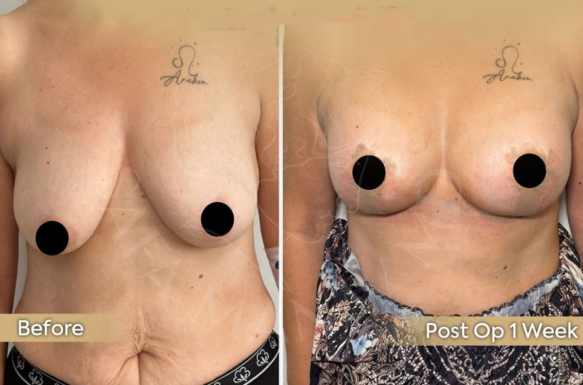 Before and after breast lift with round implants at Dr. Safa Manav Clinic, 1 week result