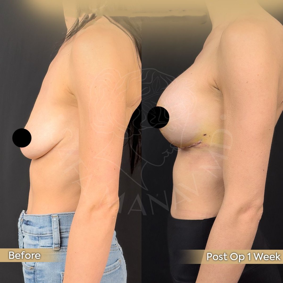 Avant/après lifting mammaire avec implants ronds à la clinique Dr. Safa Manav, résultat 1 semaine