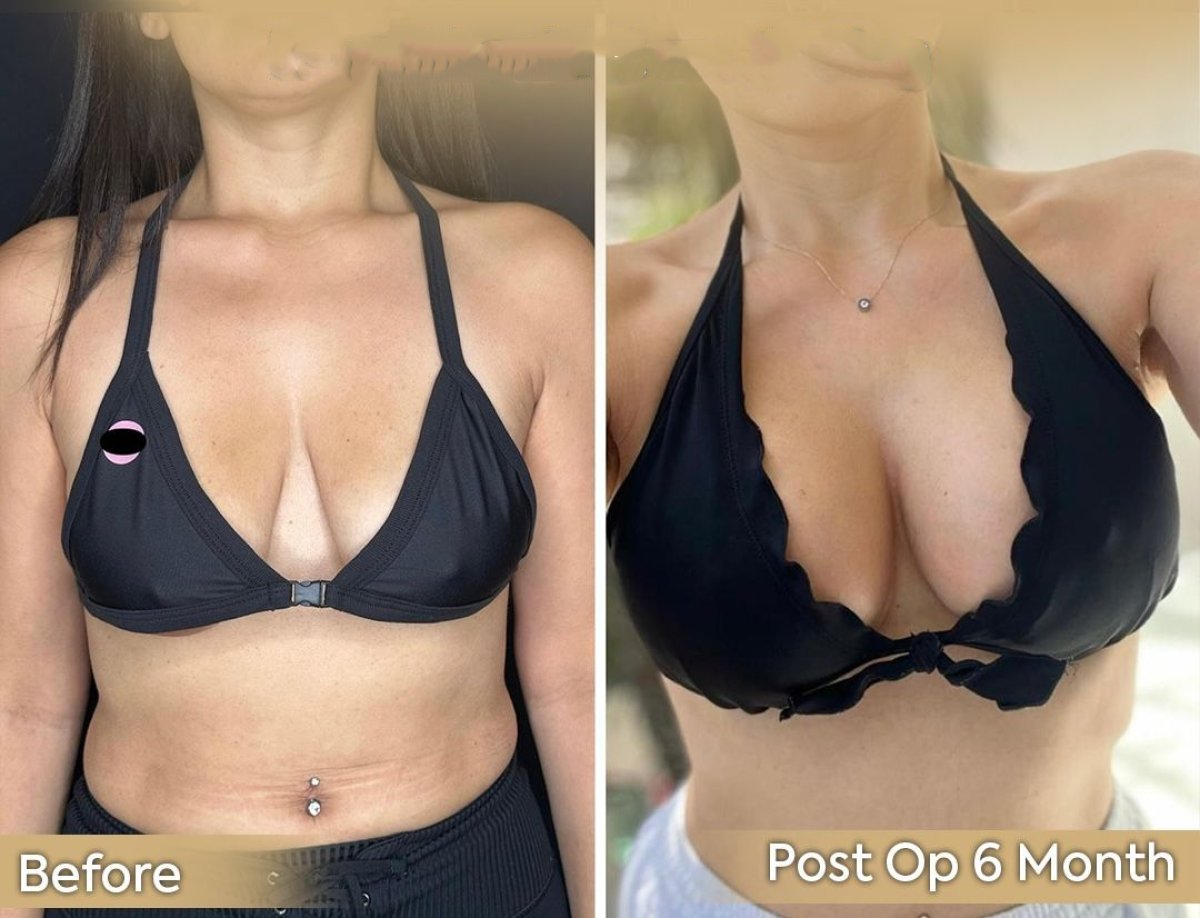 Antes y después de mastopexia con implantes redondos en Dr. Safa Manav Clinic, 6 meses