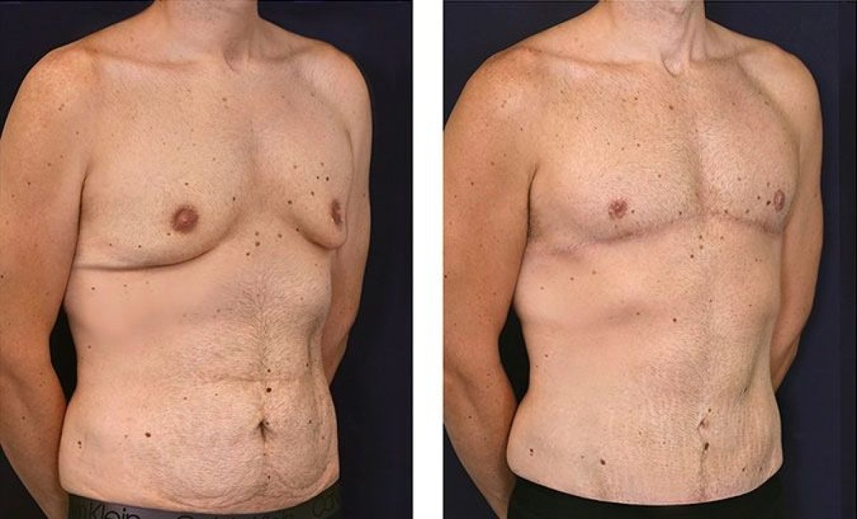 Résultats avant/après abdominoplastie homme à la clinique Dr. Alexandro Aguilera