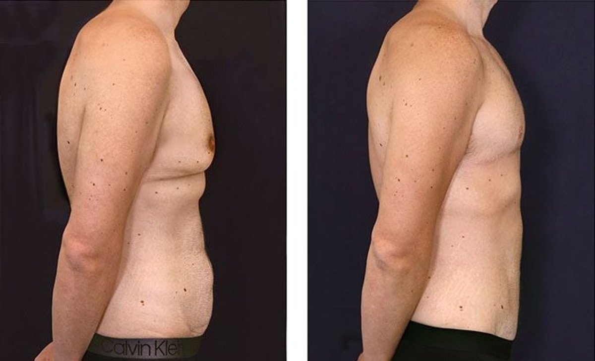 نتائج شد البطن قبل وبعد في Dr. Alexandro Aguilera - Plastic Surgery، بطن مسطح