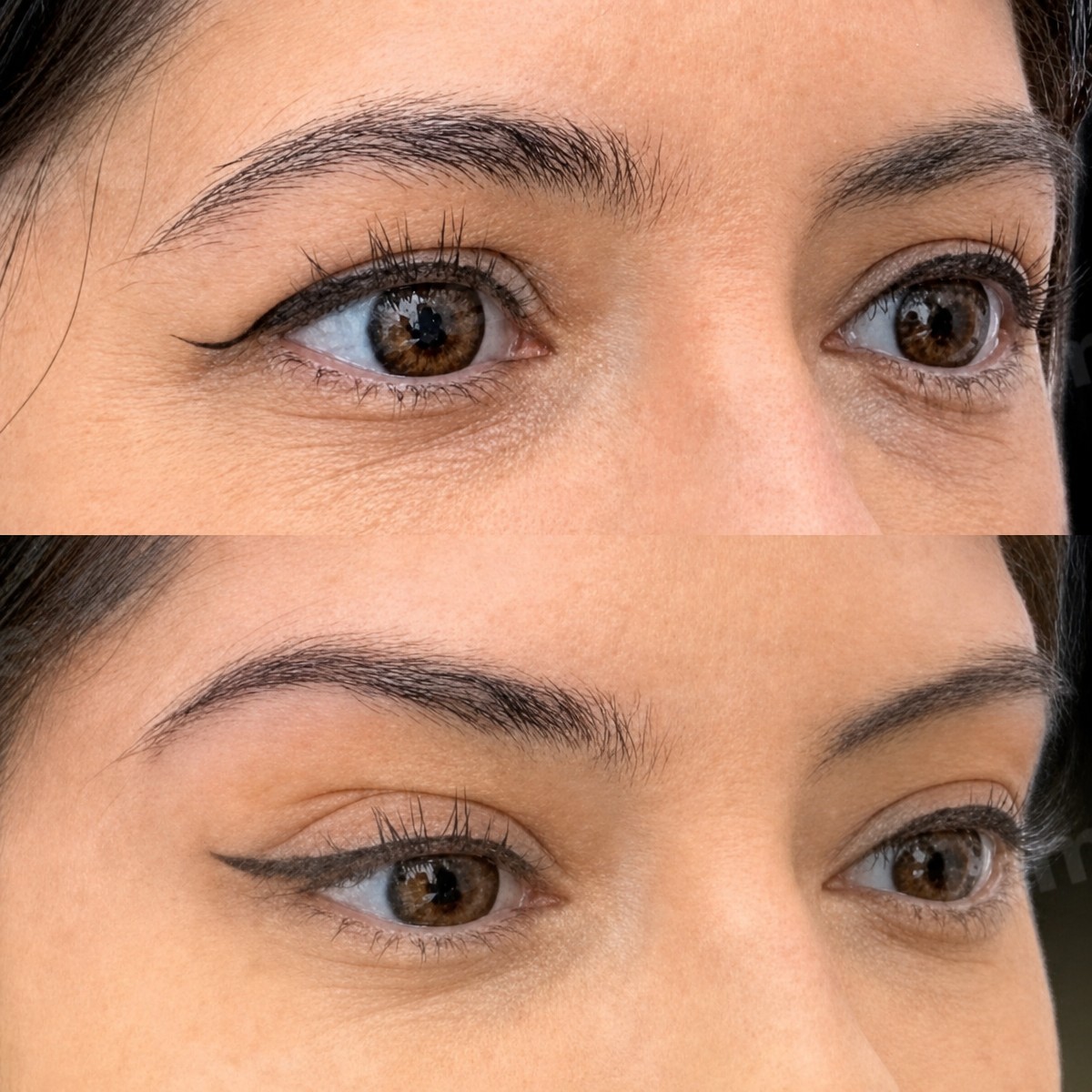 نتائج قبل وبعد عملية Fox Eye Lift في مستشفى Memorial Göztepe، رفع محيط العين