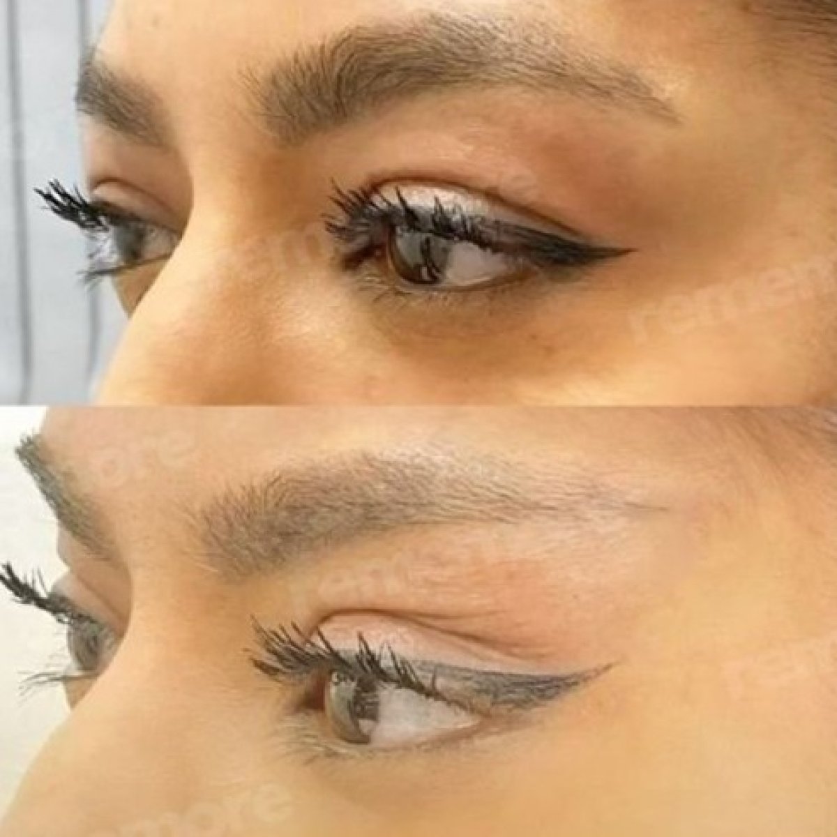 Efekty fox eye lift przed i po w Memorial Göztepe Hospital, uniesiony kontur oka