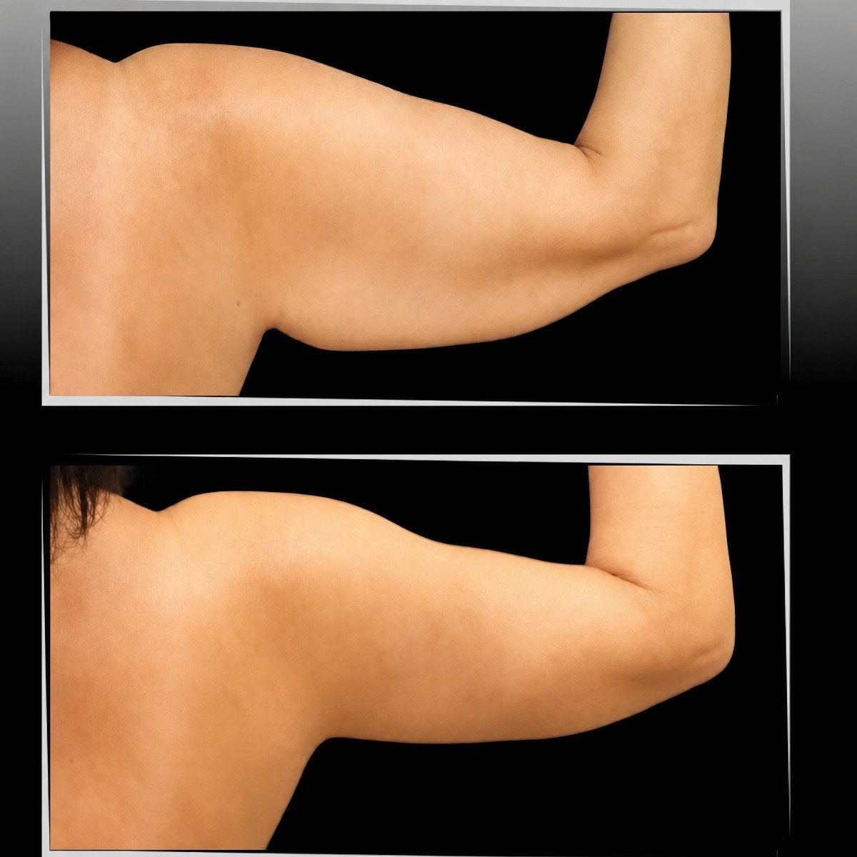 Before and after arm lift results at Dr. Ilker Manavbasi's Clinic, improved arm contour