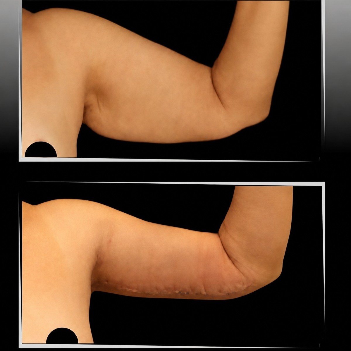 Before and after arm lift results at Dr. Ilker Manavbasi's Clinic, improved arm contour