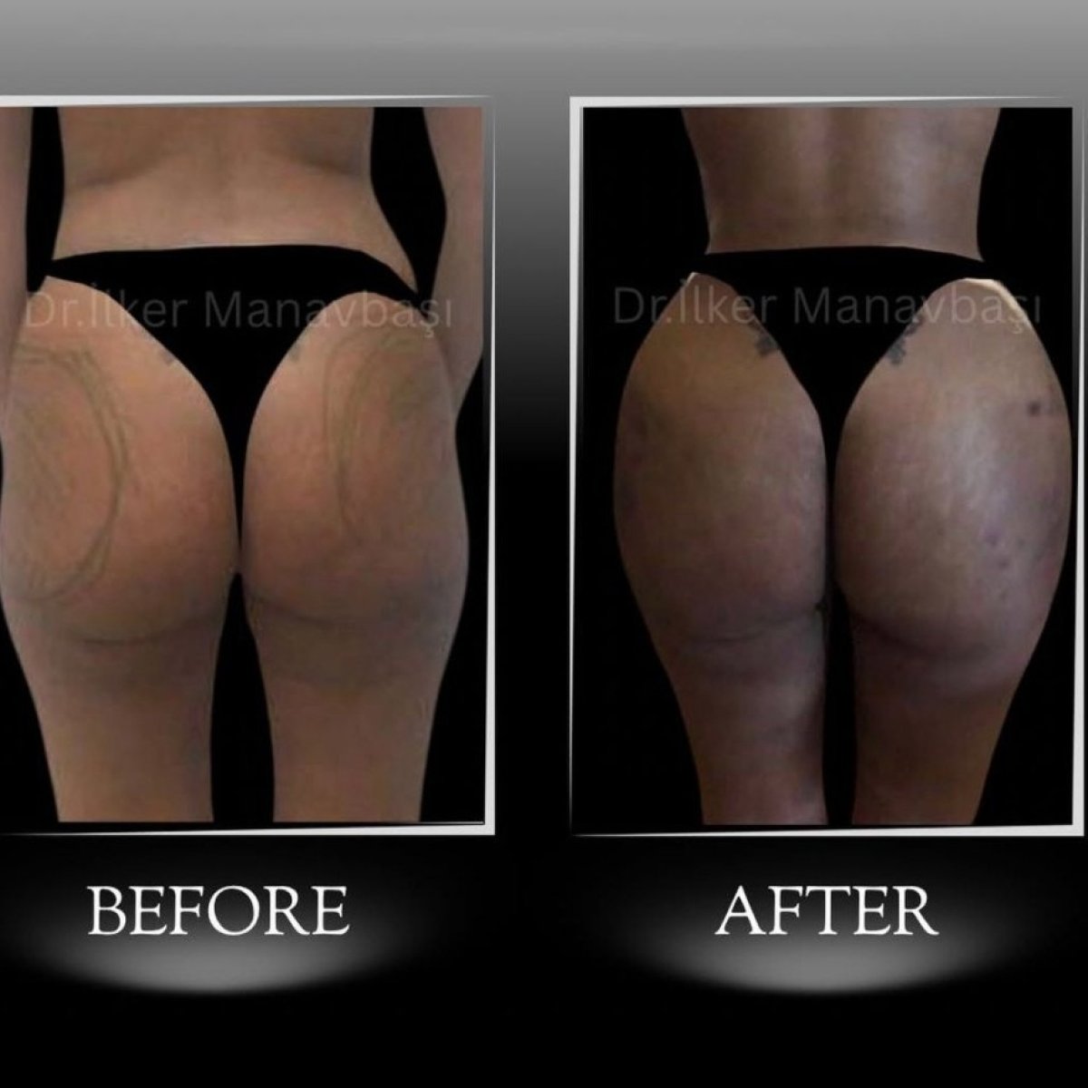 Before and after Brazilian Butt Lift results at Dr. Ilker Manavbasi's Clinic, enhanced curves