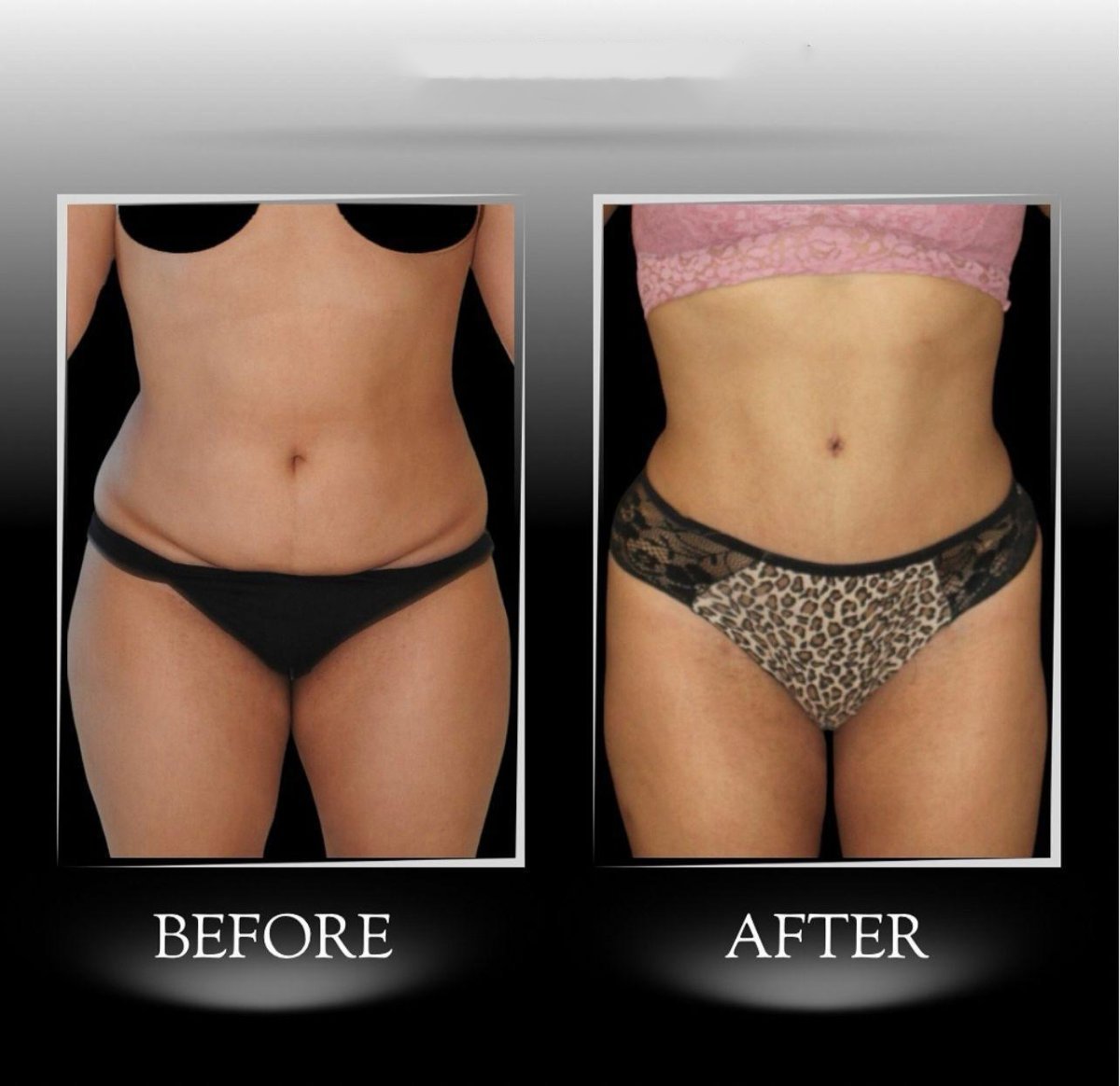 Résultats avant/après abdominoplastie à la clinique Dr Ilker Manavbasi, ventre plat