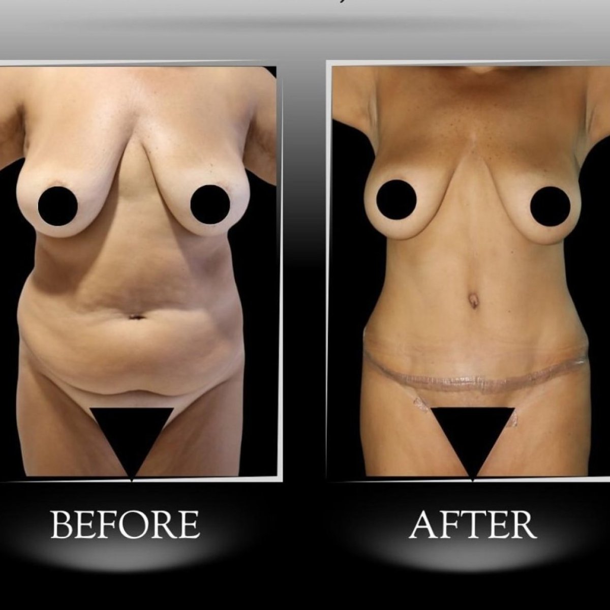 Résultats avant/après abdominoplastie à la clinique Dr Ilker Manavbasi, ventre plat