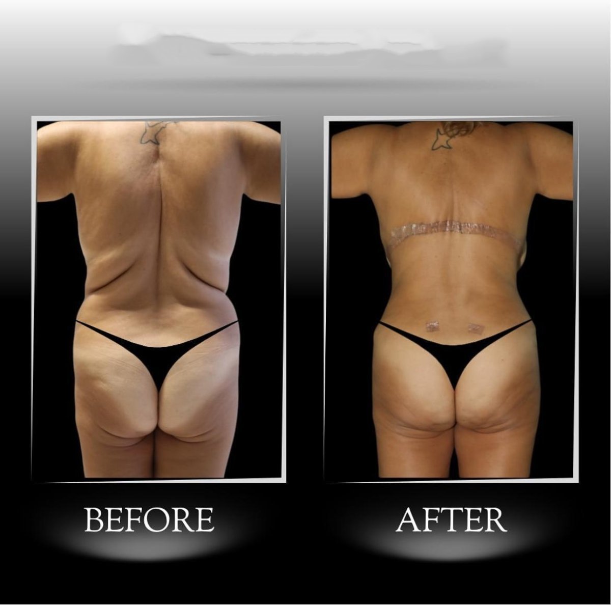 Back lift before and after results at Dr. Ilker Manavbasi's Clinic, improved back contour