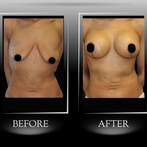 Breast Lift with Implants — Companion Stay & Special Bra Included - photo 4