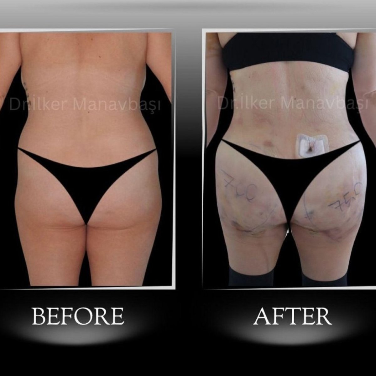 Before and after Brazilian Butt Lift results at Dr. Ilker Manavbasi's Clinic, enhanced curves