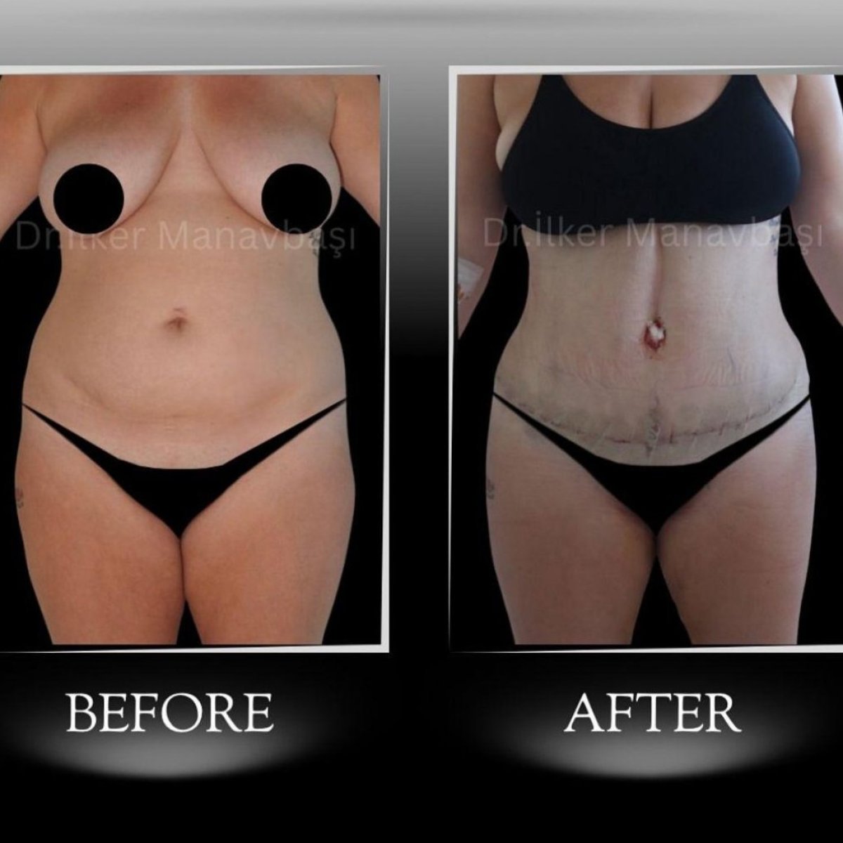 Before and after tummy tuck results at Dr. Ilker Manavbasi's Clinic, improved abdomen contour