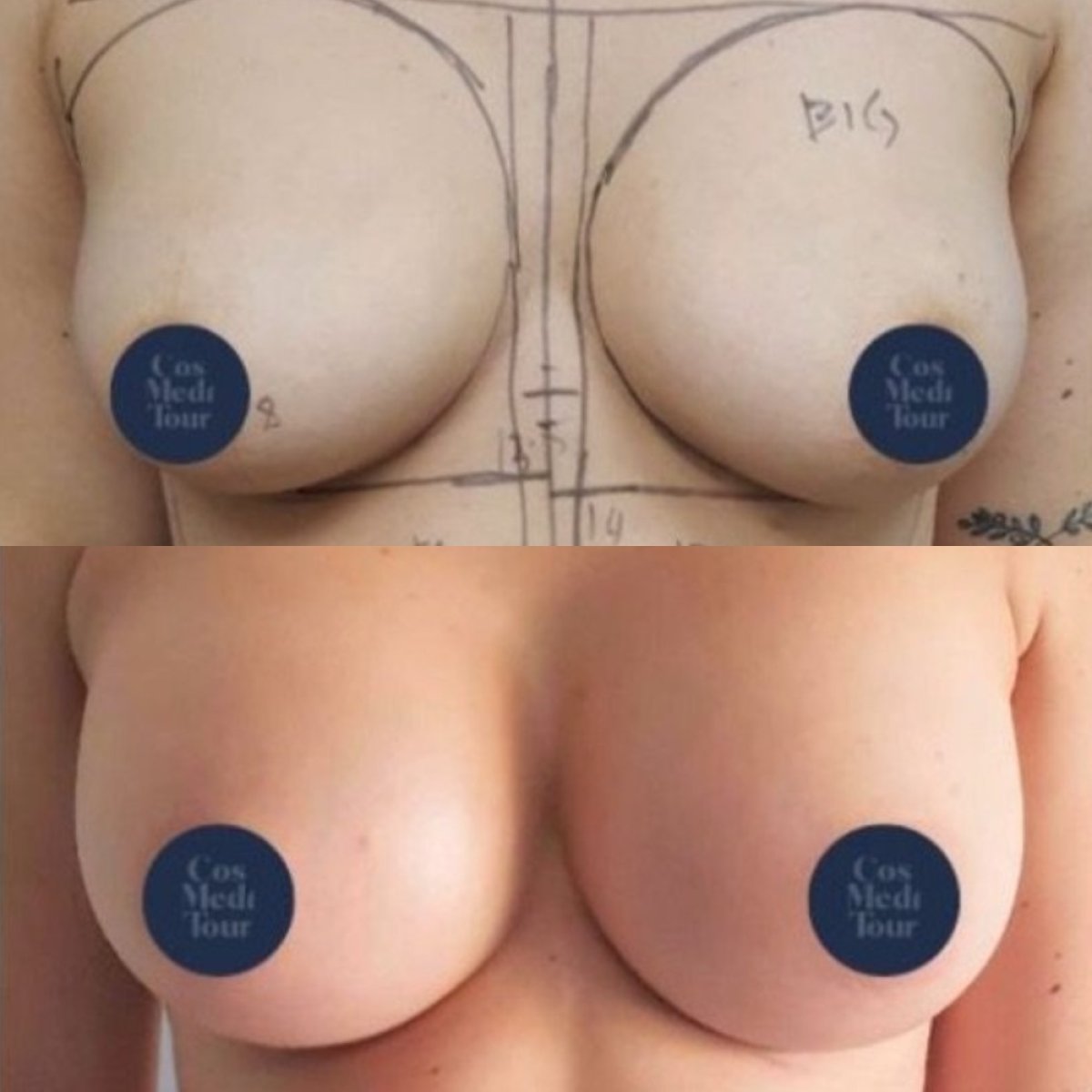 Before and after breast augmentation results at ID Clinic Bangkok, enhanced breast shape