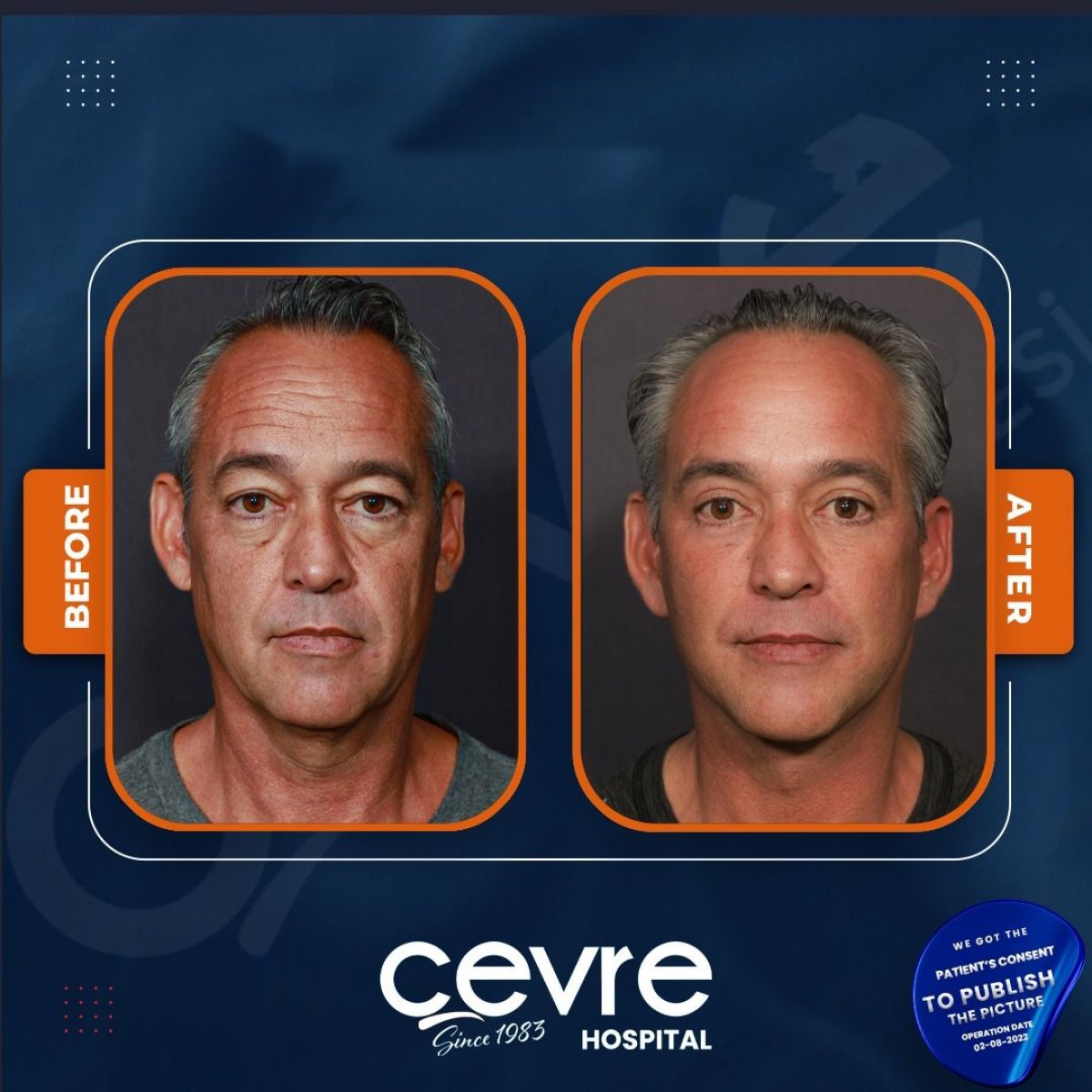 Facelift before and after results at Cevre Hospital, visible facial rejuvenation in male patient