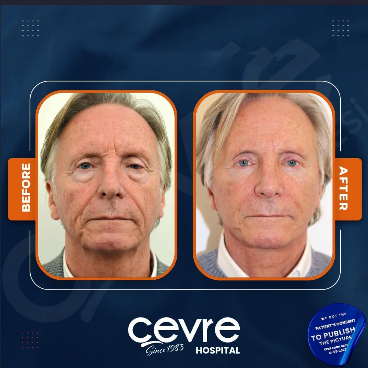 نتائج شد الوجه قبل وبعد في Adem and Havva Medical Center، تجديد شباب الوجه