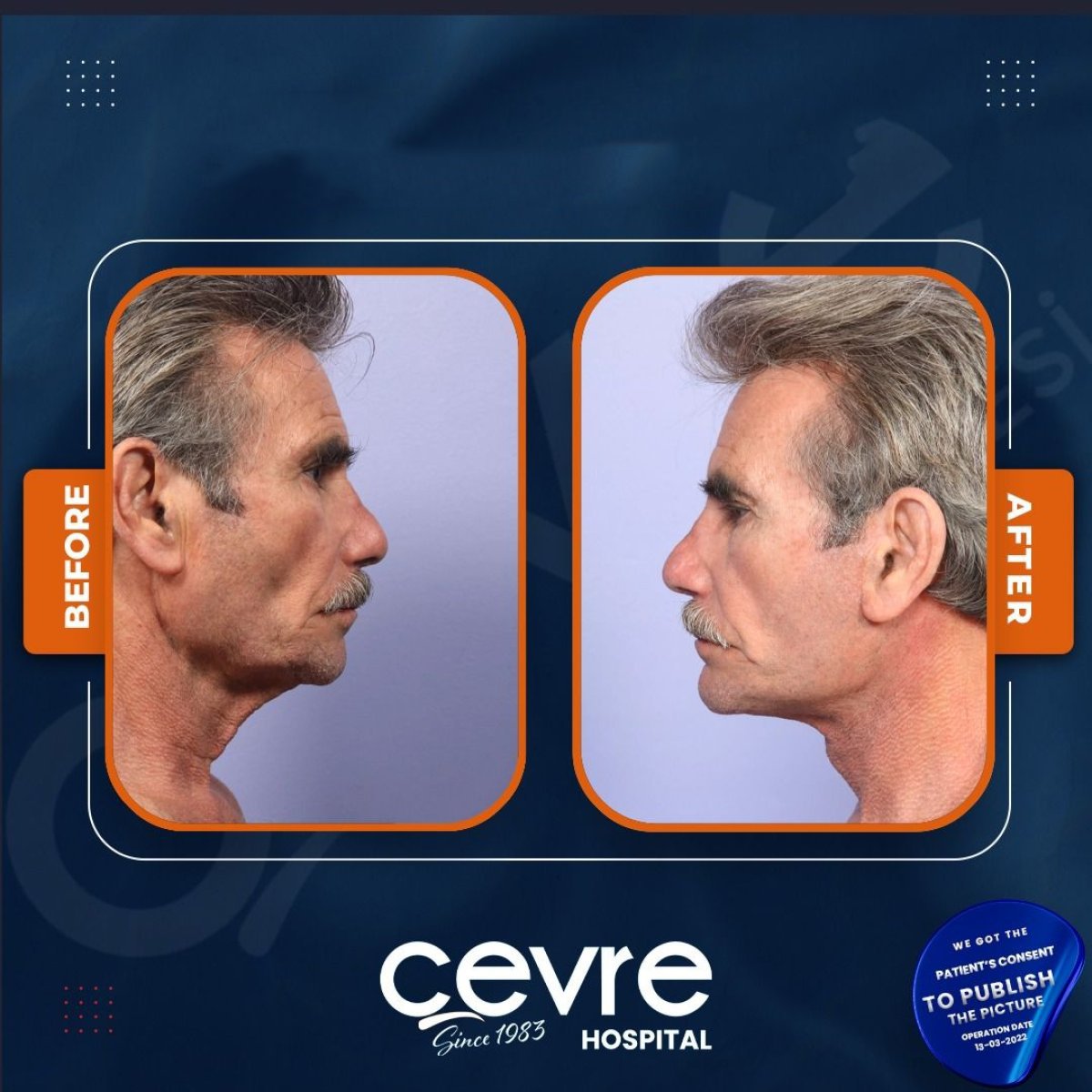 Facelift before and after results at Adem and Havva Medical Center, visible facial rejuvenation