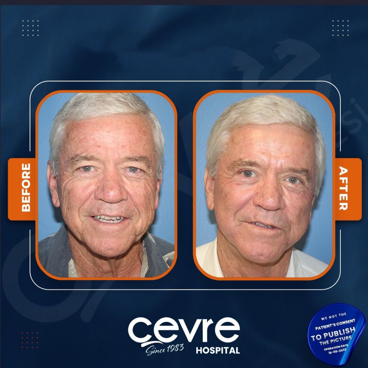 Resultados de lifting facial antes y después en Adem and Havva Medical Center, rejuvenecimiento