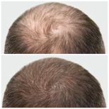 صور قبل وبعد زراعة الشعر للدكتور 