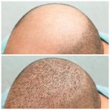 صور قبل وبعد زراعة الشعر للدكتور 