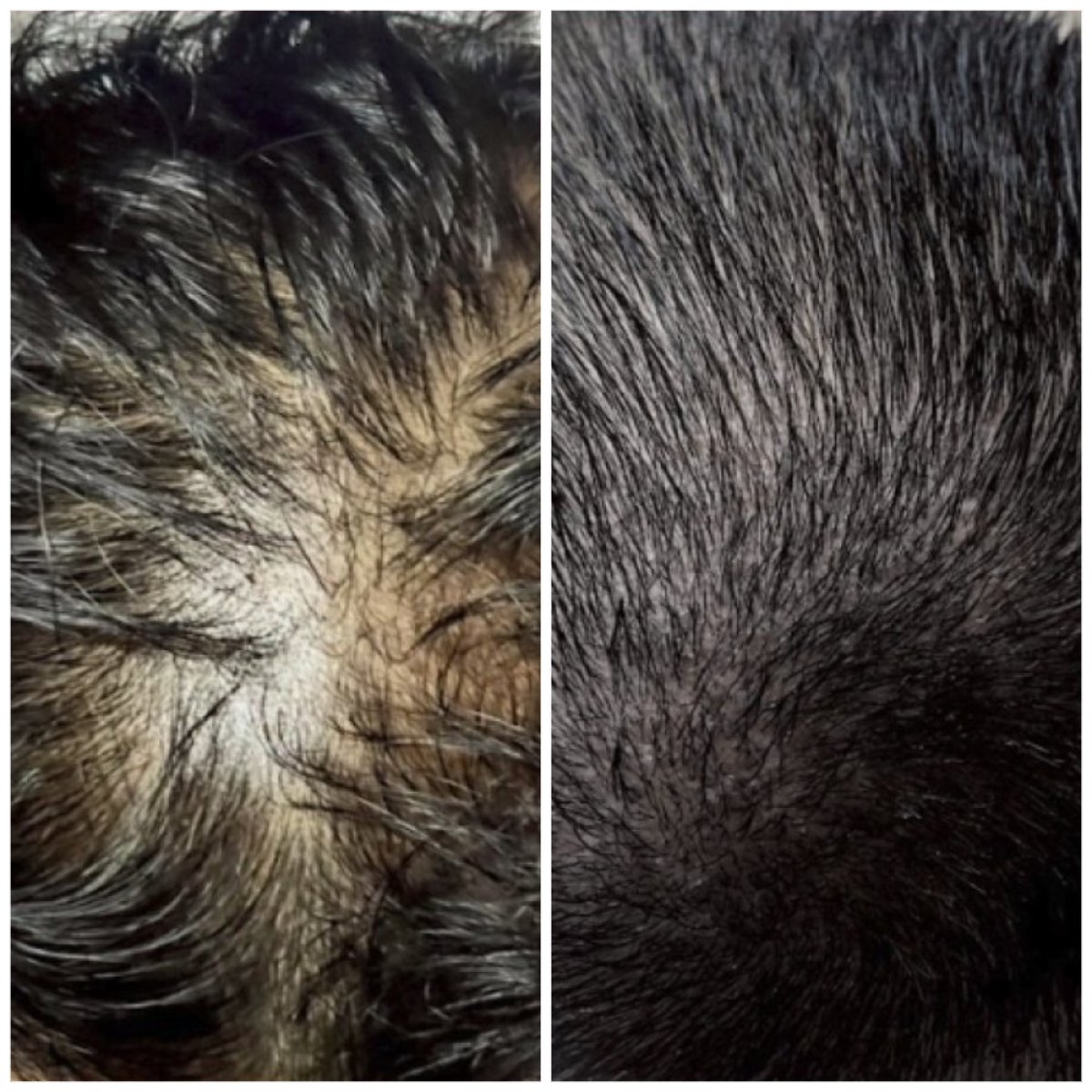 Before and after hair transplant results at Somchai Clinic – visible hair density improvement