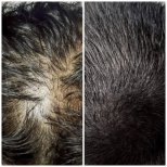 صور قبل وبعد زراعة الشعر للدكتور 