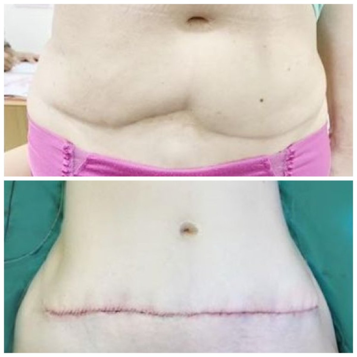 Результаты до и после абдоминопластики в Somchai Clinic – улучшенный контур живота