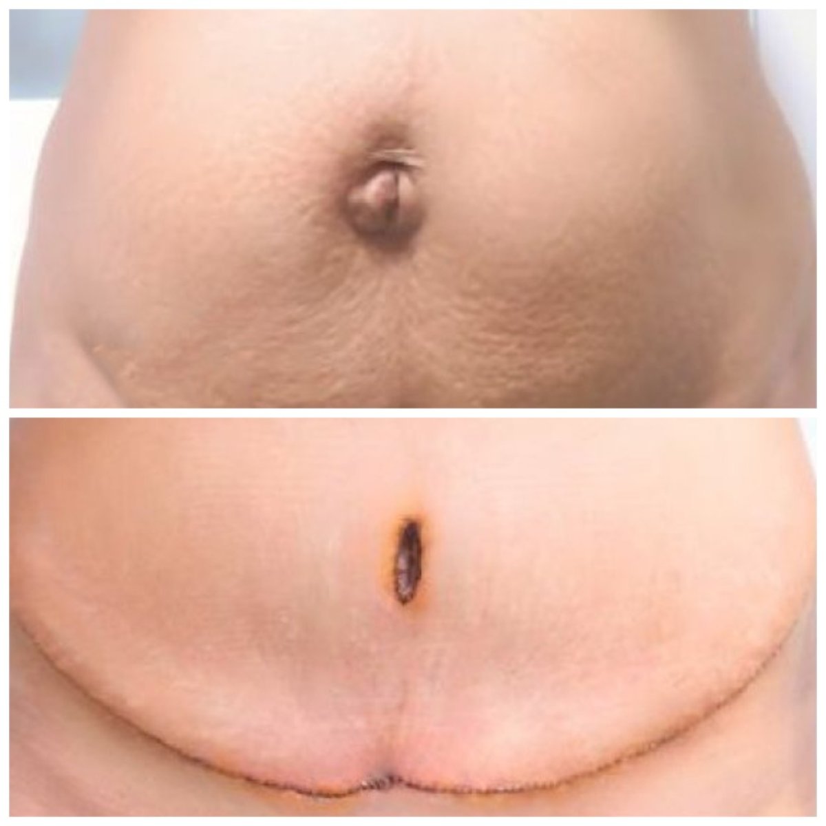 Resultados de abdominoplastia antes y después en Somchai Clinic – contorno abdominal mejorado