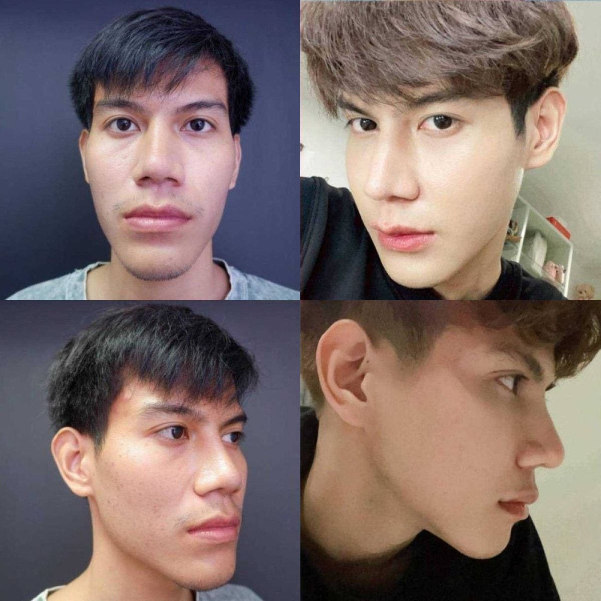 Resultados de antes y después de remodelación de mandíbula en Asia Cosmetic Hospital