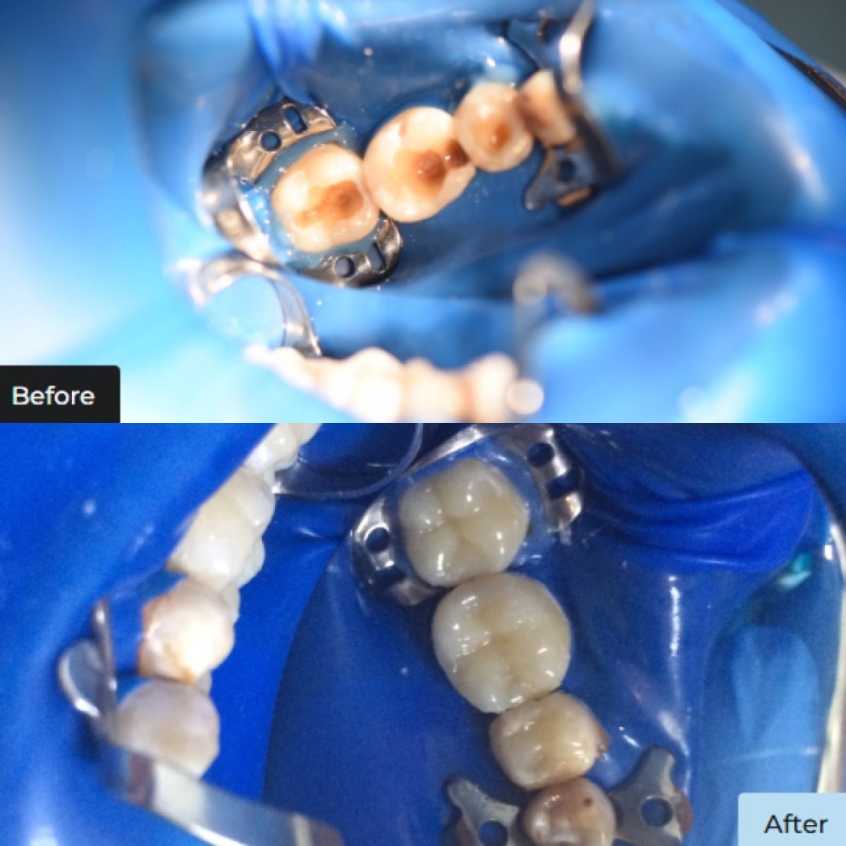 Resultados antes y después de relleno estético compuesto en Dynasty Stomatology, molares restaurados