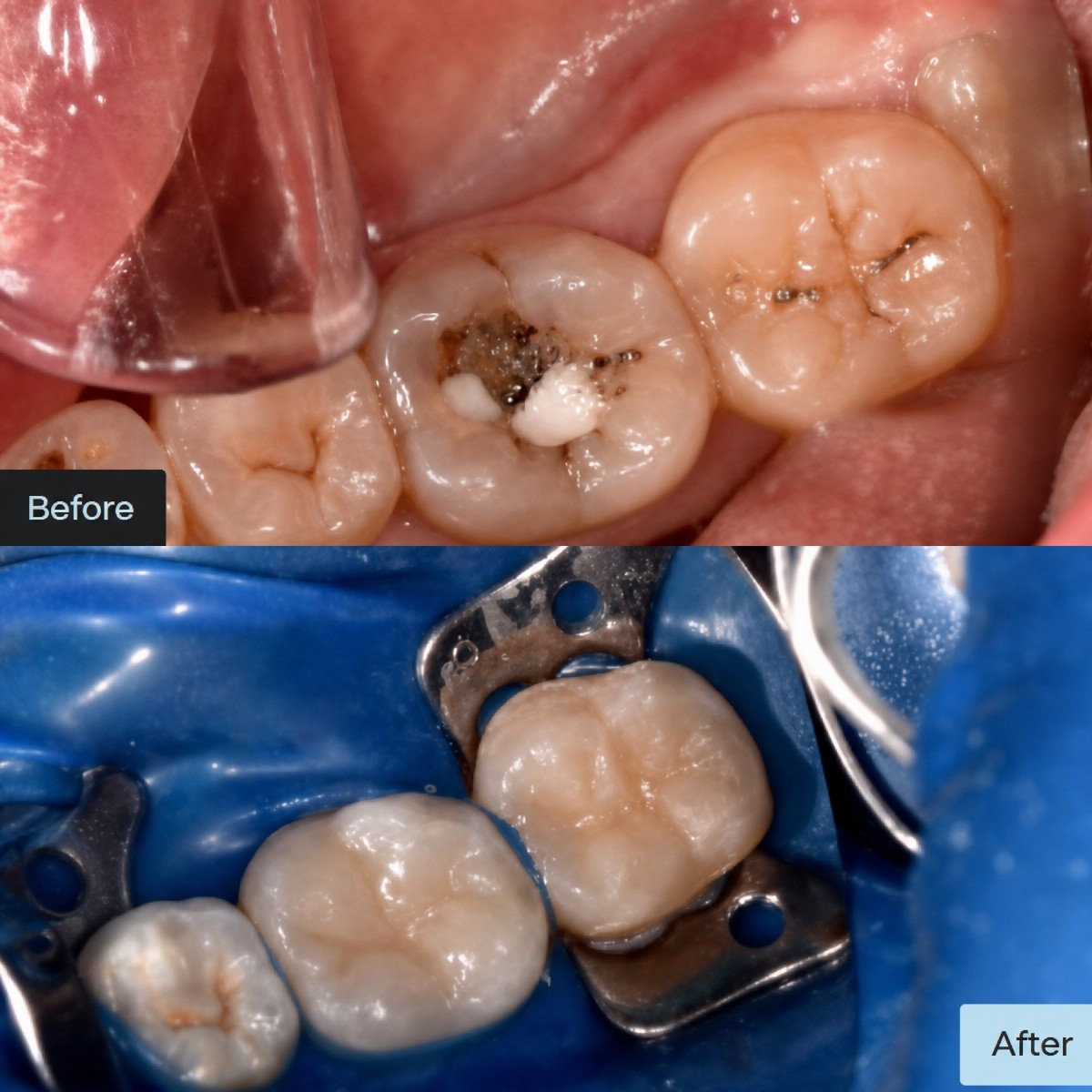 Resultados antes y después de empaste estético en Dynasty Stomatology, restauración dental