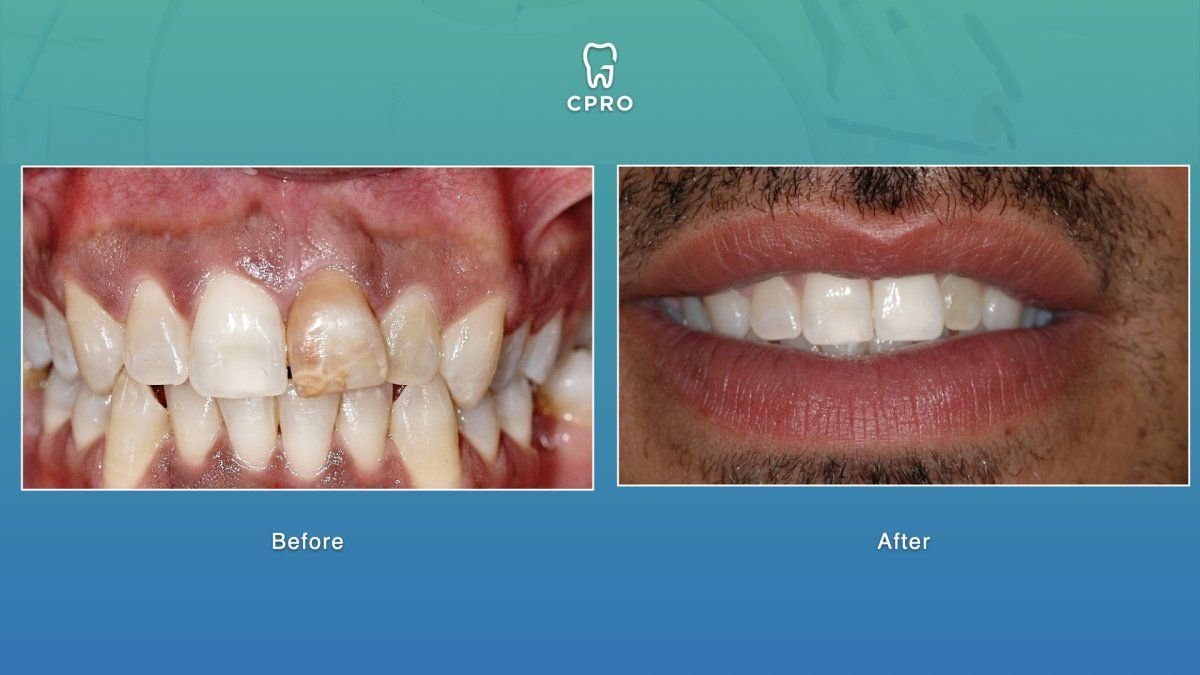 Resultados antes y después de carillas de porcelana en CPRO Dental Clinic, sonrisa mejorada