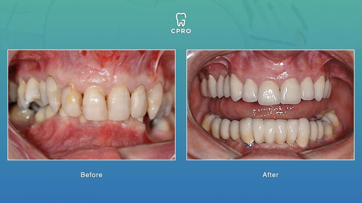 نتائج قبل وبعد عدسات الأسنان الخزفية في CPRO Dental Clinic، تحسين مظهر الابتسامة