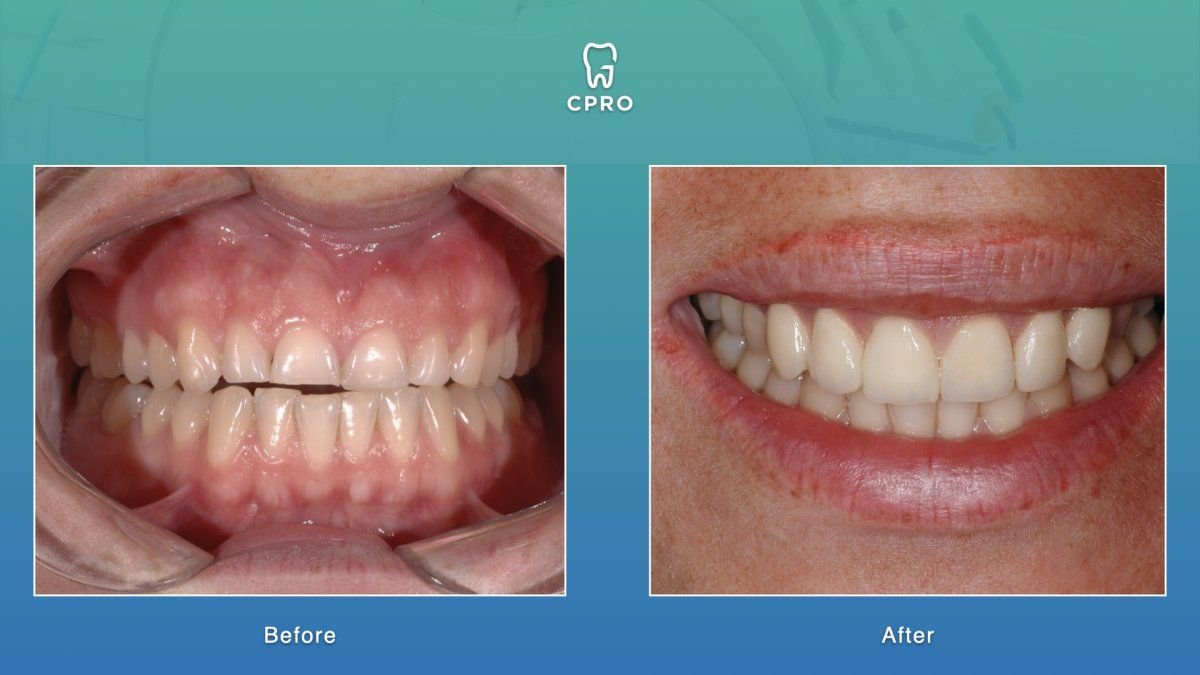 Resultados antes y después de carillas de porcelana en CPRO Dental Clinic – sonrisa mejorada