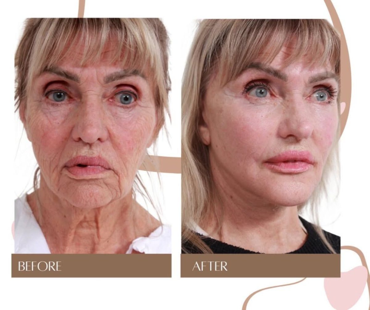 Resultados de lifting facial antes y después en InSense Clinic (SV Plastic Surgery Clinic), rejuvenecimiento