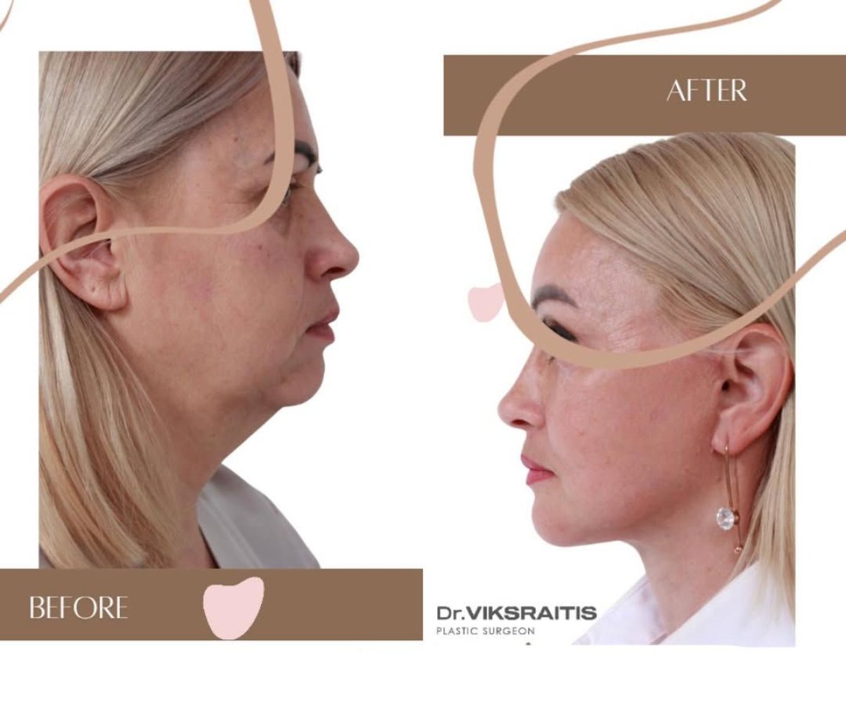 Facelift before and after results at InSense Clinic (SV Plastic Surgery Clinic), facial rejuvenation