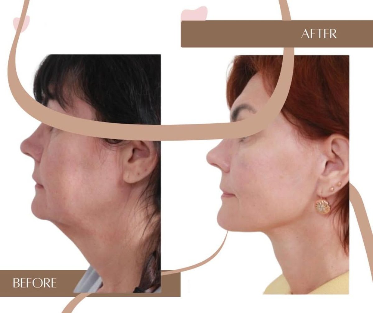نتائج شد الوجه قبل وبعد في InSense Clinic (SV Plastic Surgery Clinic)، تحسين خط الفك