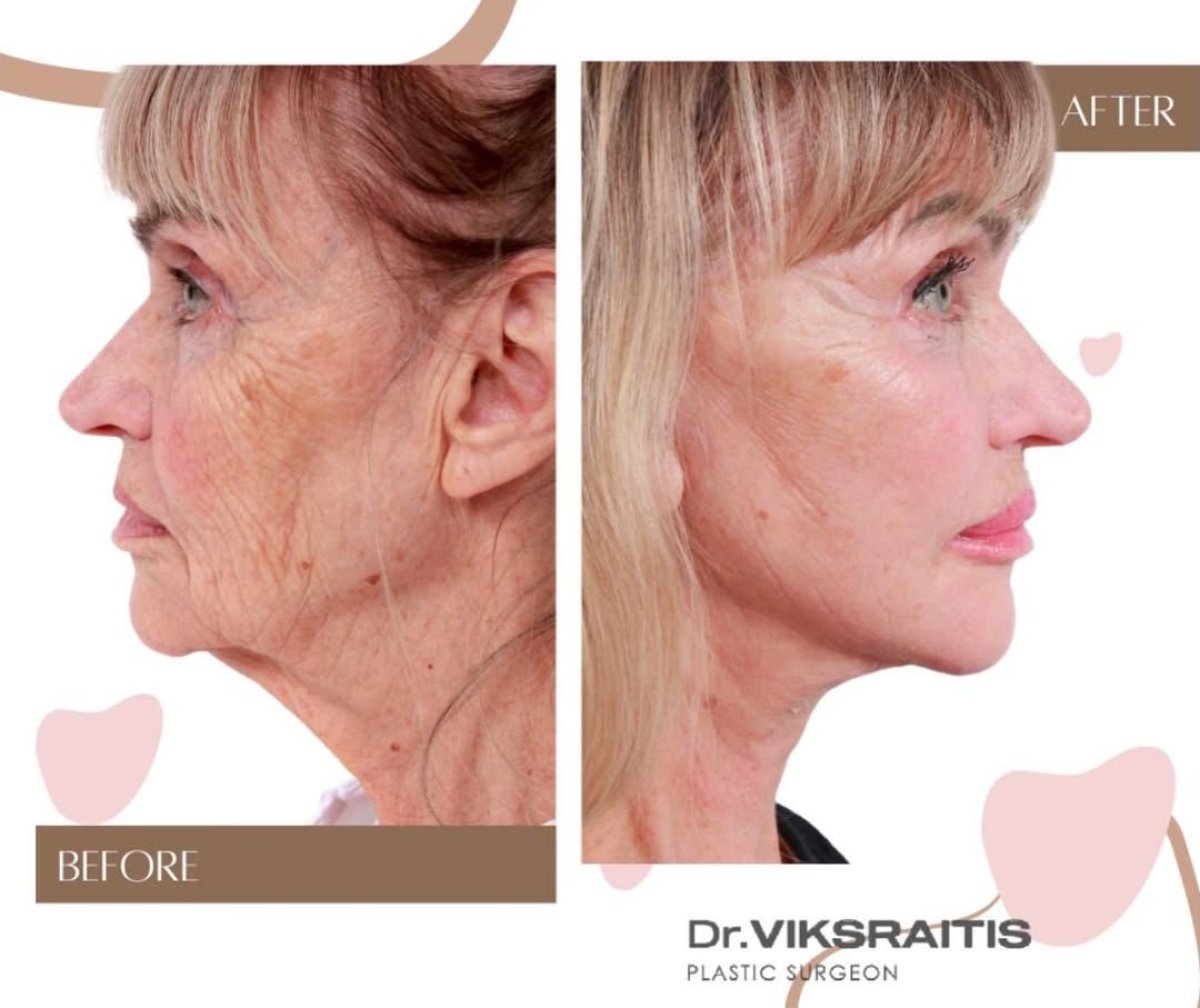Facelift before and after results at InSense Clinic (SV Plastic Surgery Clinic), visible rejuvenation