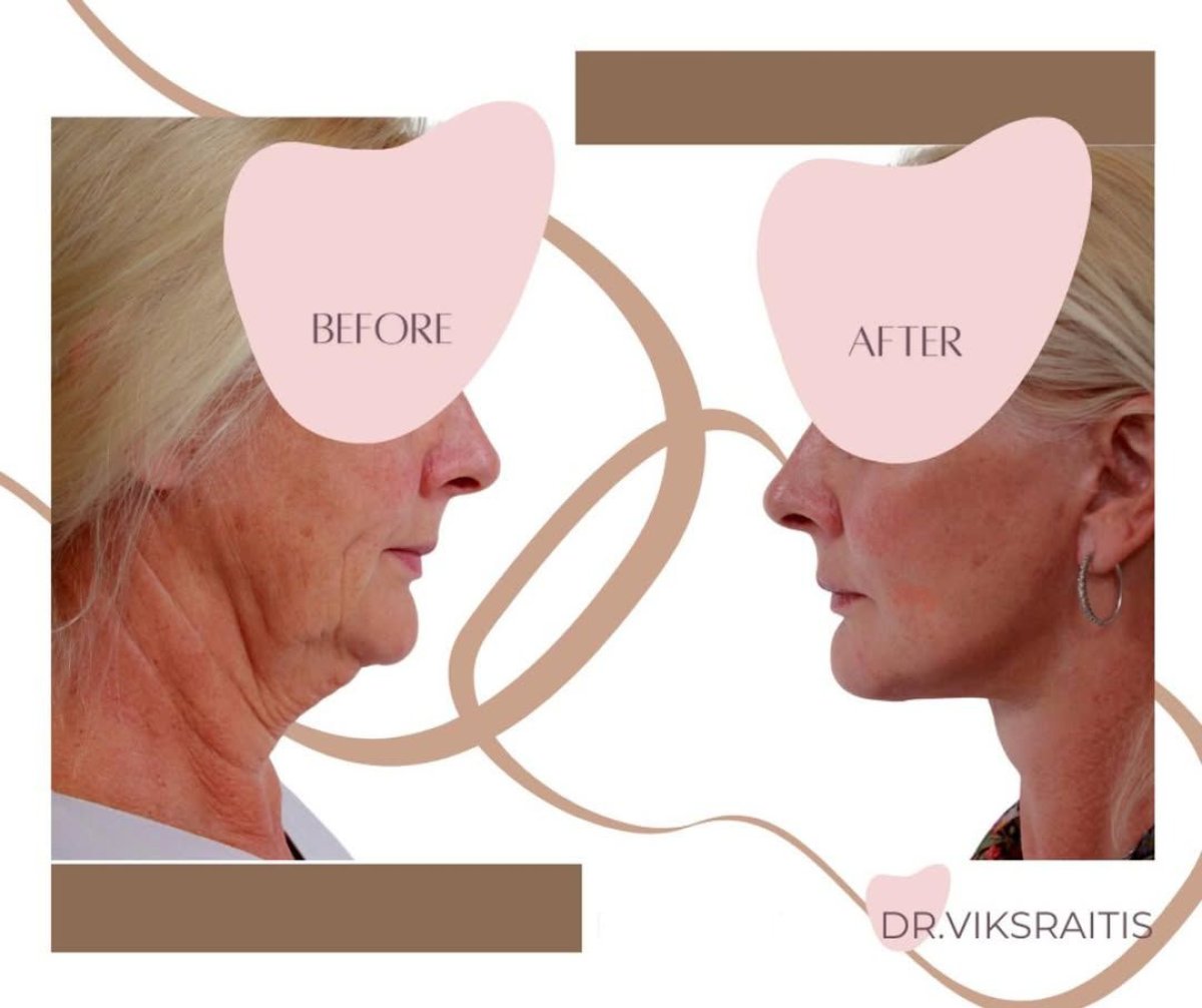 Facelift before and after results at InSense Clinic (SV Plastic Surgery Clinic), visible neck lift