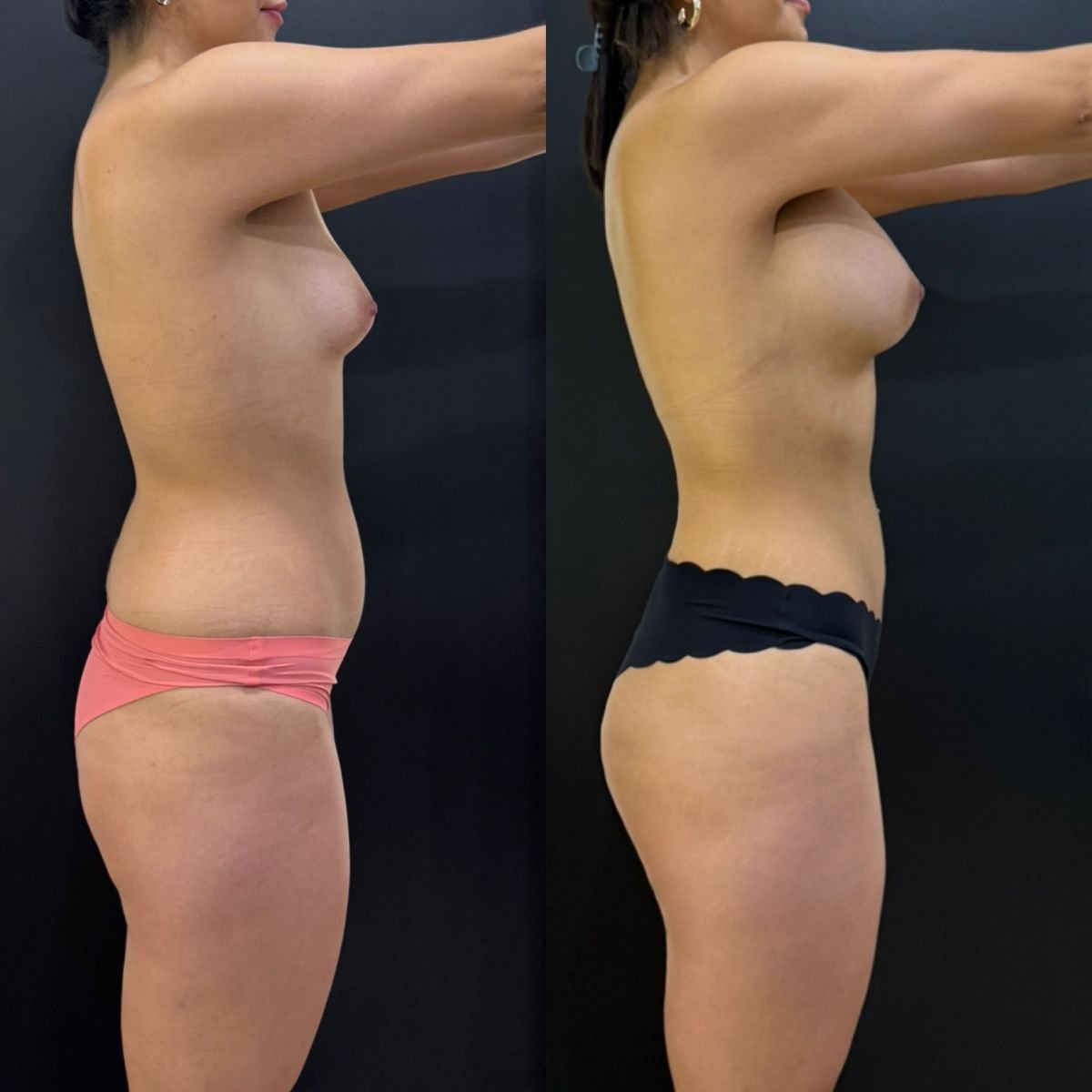 نتائج قبل وبعد شفط الدهون 360 في عيادة Dr. Alexandro Aguilera - Plastic Surgery