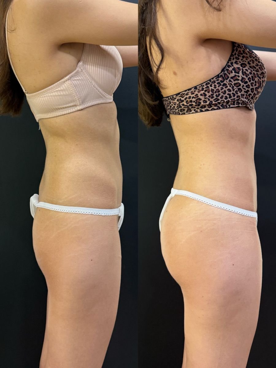 Before and after 360 liposuction results at Dr. Alexandro Aguilera - Plastic Surgery, body contouring