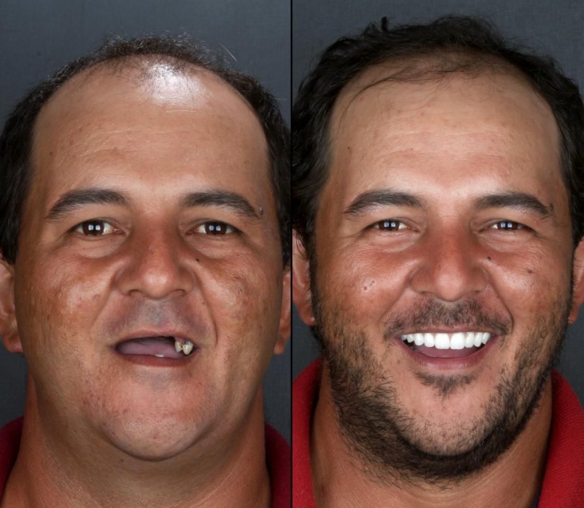 Antes y después de la instalación de dentaduras completas en European Valley Health, resultado sonrisa