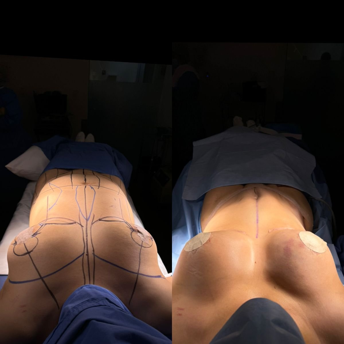 نتائج شد الثدي قبل وبعد في Dr. Alexandro Aguilera - Plastic Surgery، تحسين الشكل