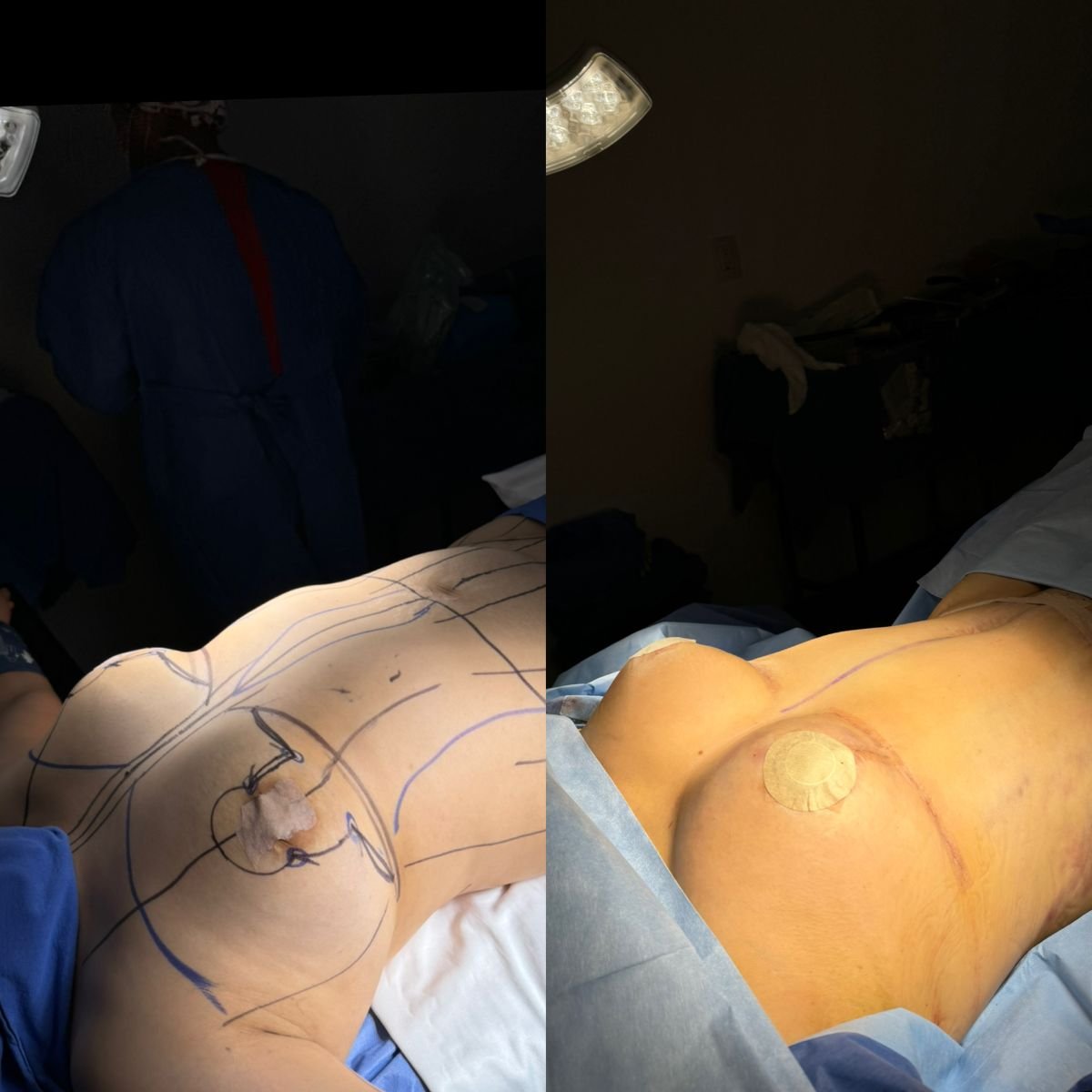 نتائج قبل وبعد رفع الثدي في عيادة Dr. Alexandro Aguilera - Plastic Surgery