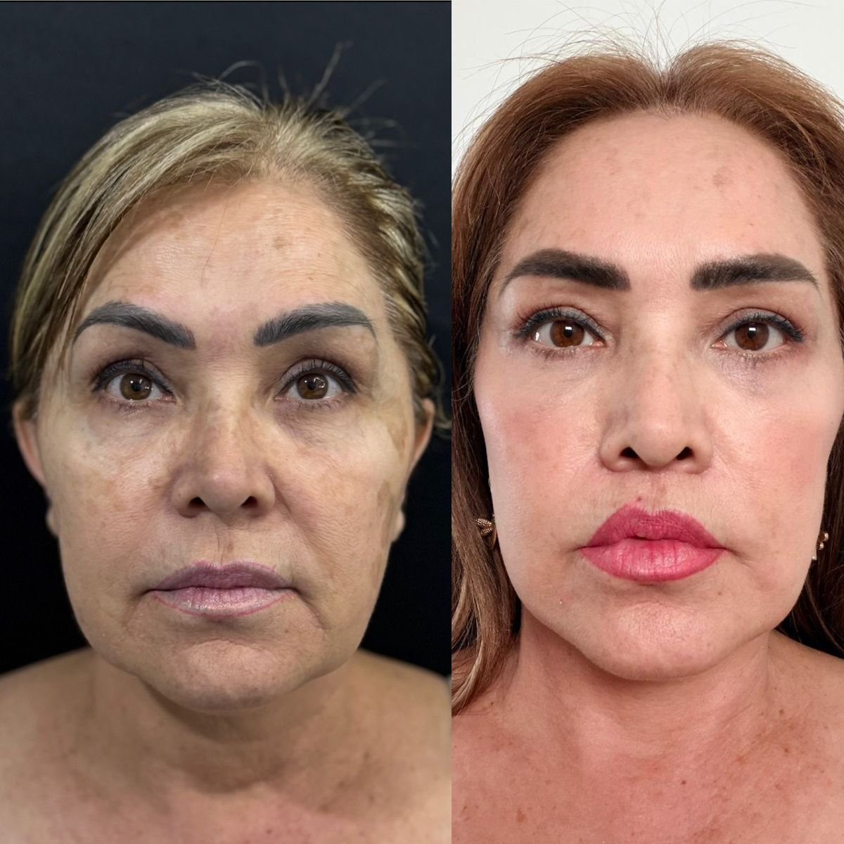 Résultats avant et après lifting du visage à Marroquín & Sandoval Plastic Surgery Clinic, rajeunissement