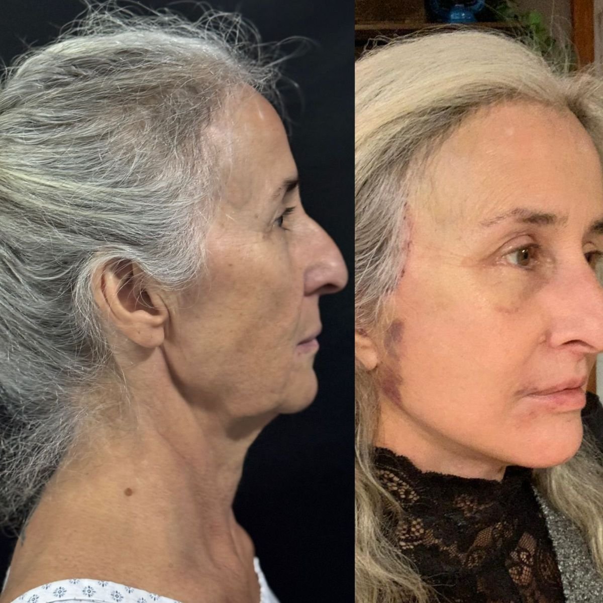 نتائج شد الوجه قبل وبعد في عيادة Marroquín & Sandoval لجراحة التجميل، تجديد شباب الوجه