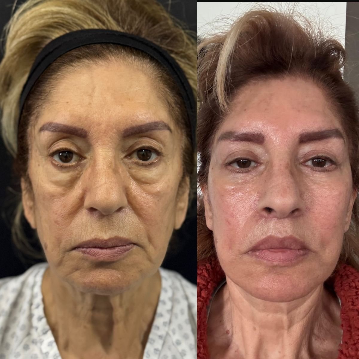نتائج شد الوجه قبل وبعد في عيادة ماروكين وساندوفال لجراحة التجميل، تجديد شباب الوجه