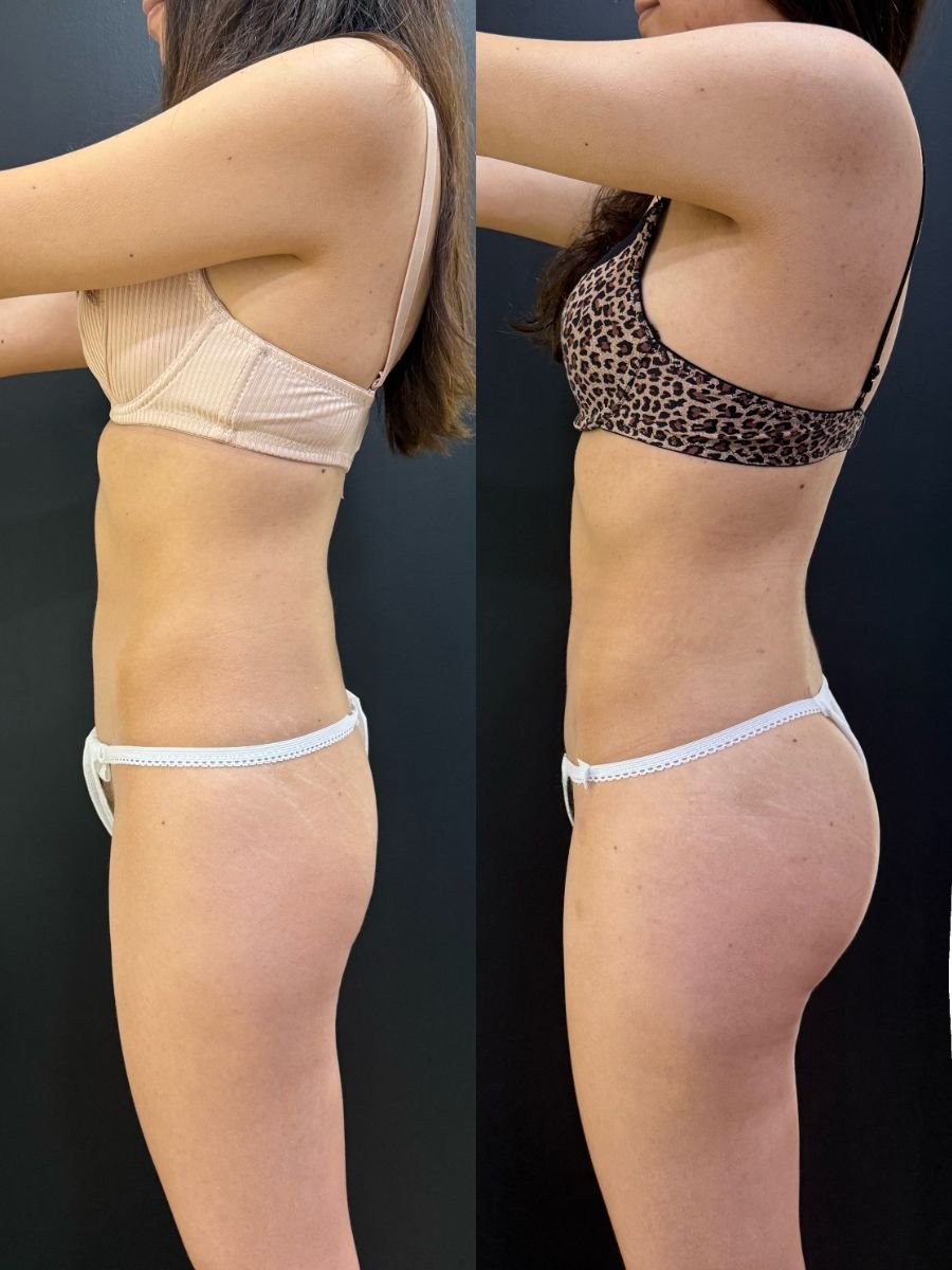 Результаты липосакции до и после в Dr. Alexandro Aguilera - Plastic Surgery, коррекция тела