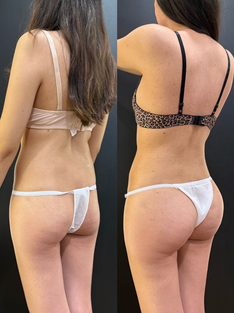 Resultados de liposucción antes y después en Dr. Alexandro Aguilera - Plastic Surgery, contorno corporal